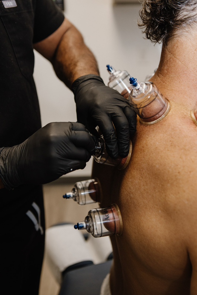 Cupping